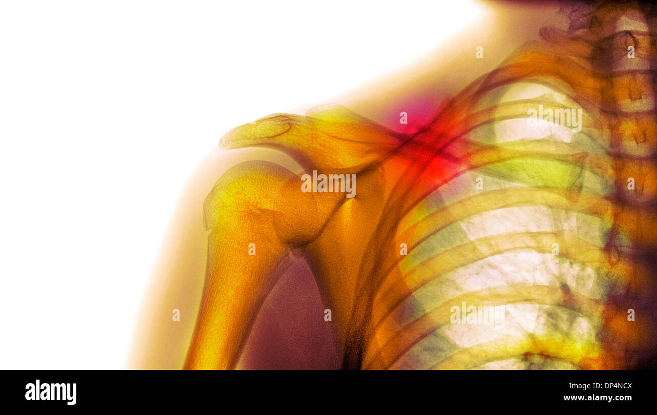 Fractured collarbone, X-ray Stock Photo