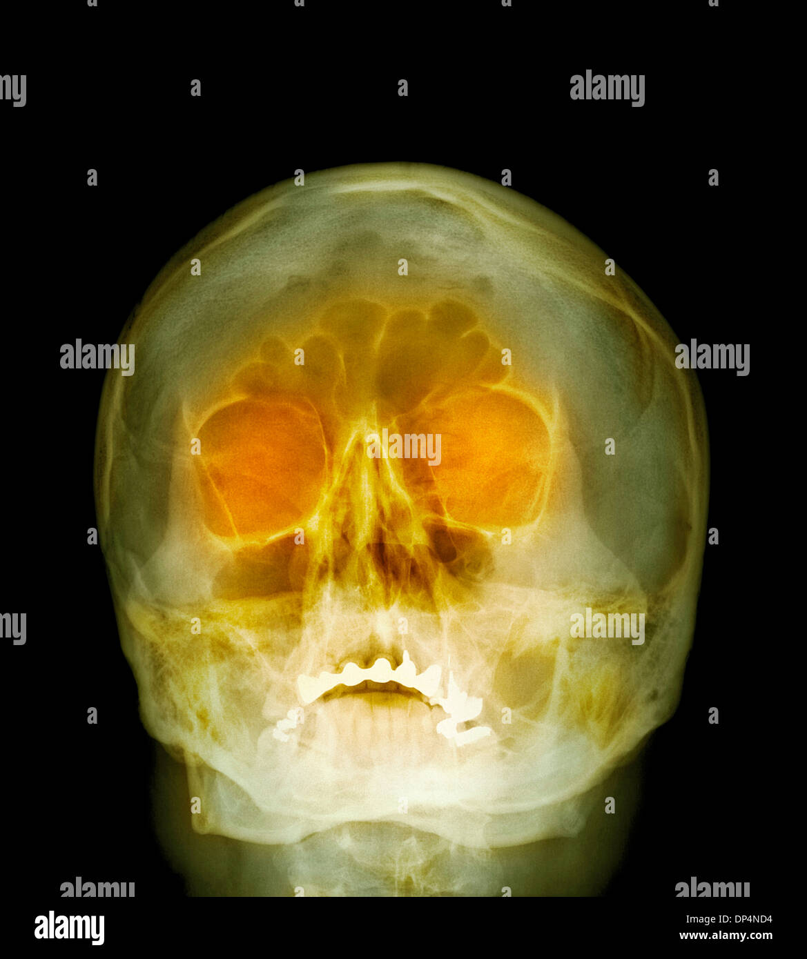 Shotgun injury, X-ray Stock Photo