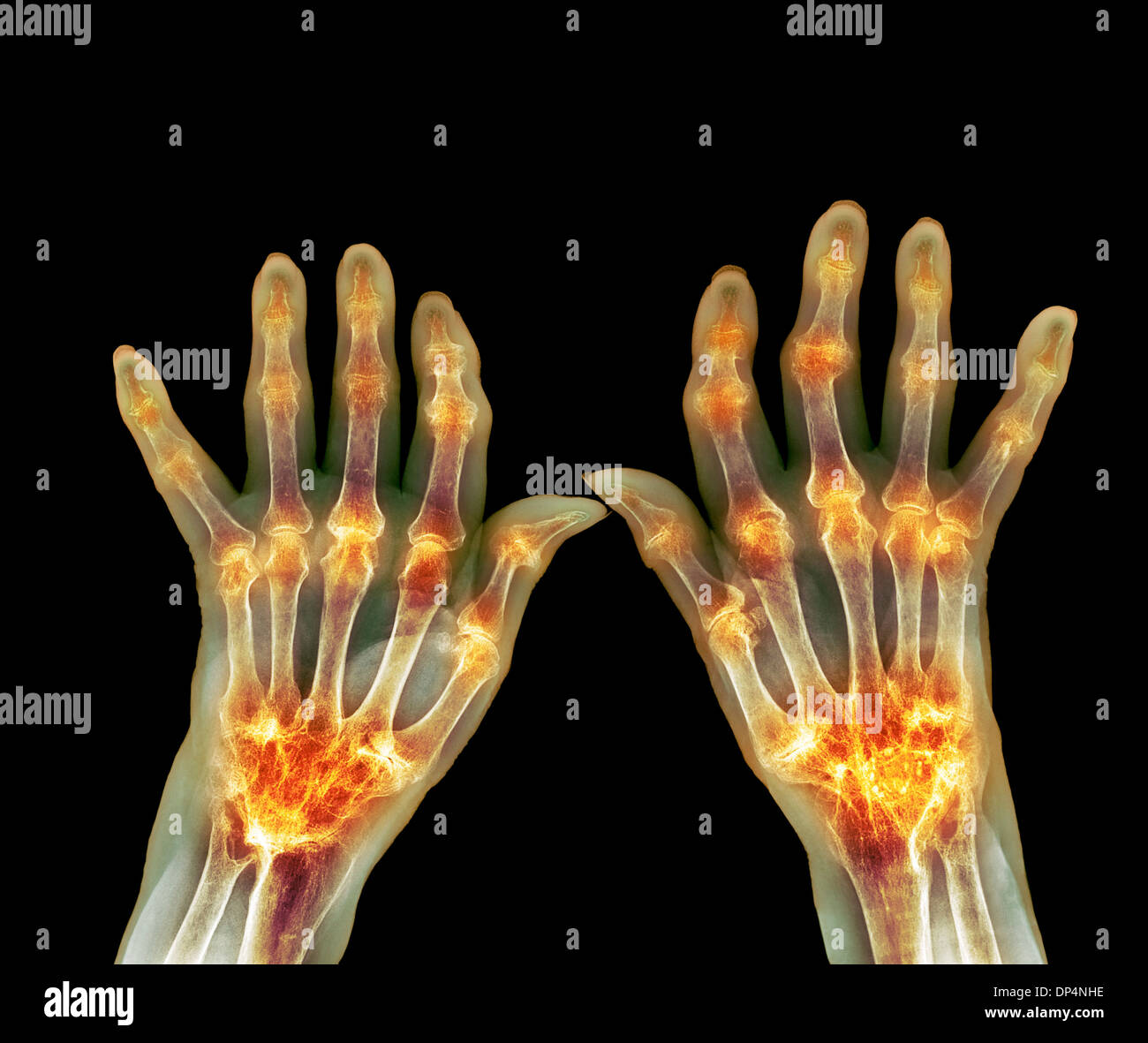 Rheumatoid arthritis, X-ray Stock Photo