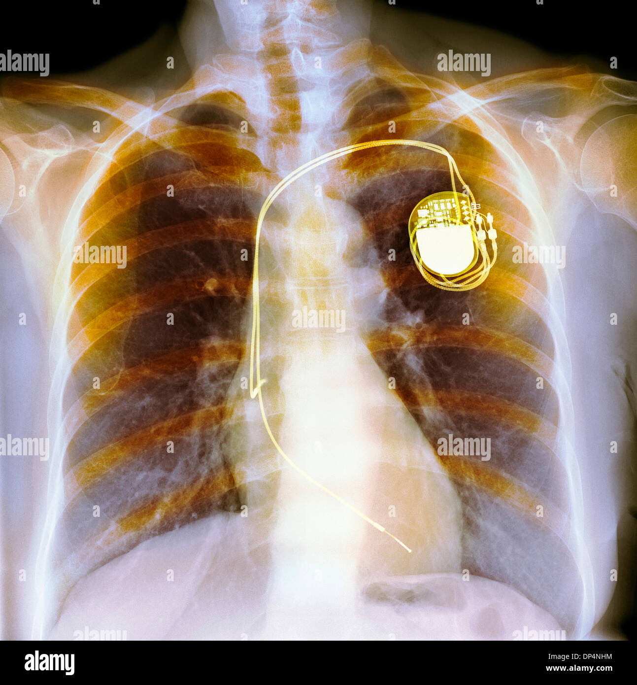 Dual chamber pacemaker, X-ray Stock Photo