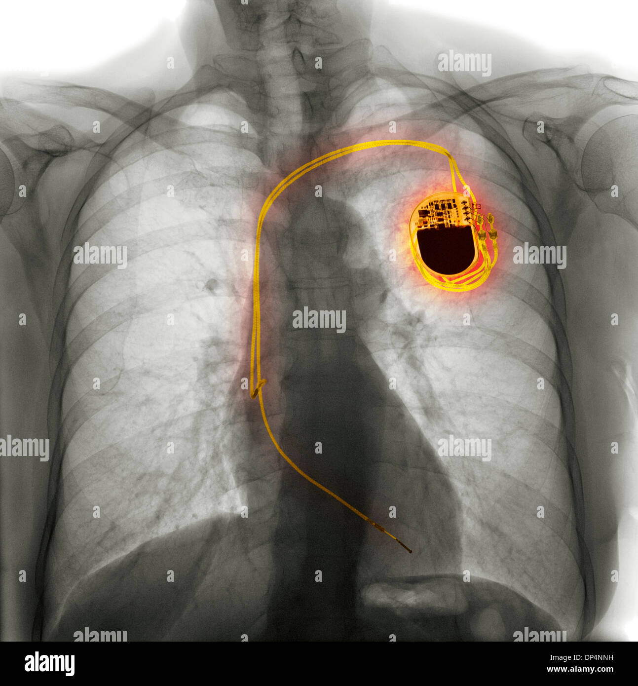 Dual chamber pacemaker, X-ray Stock Photo