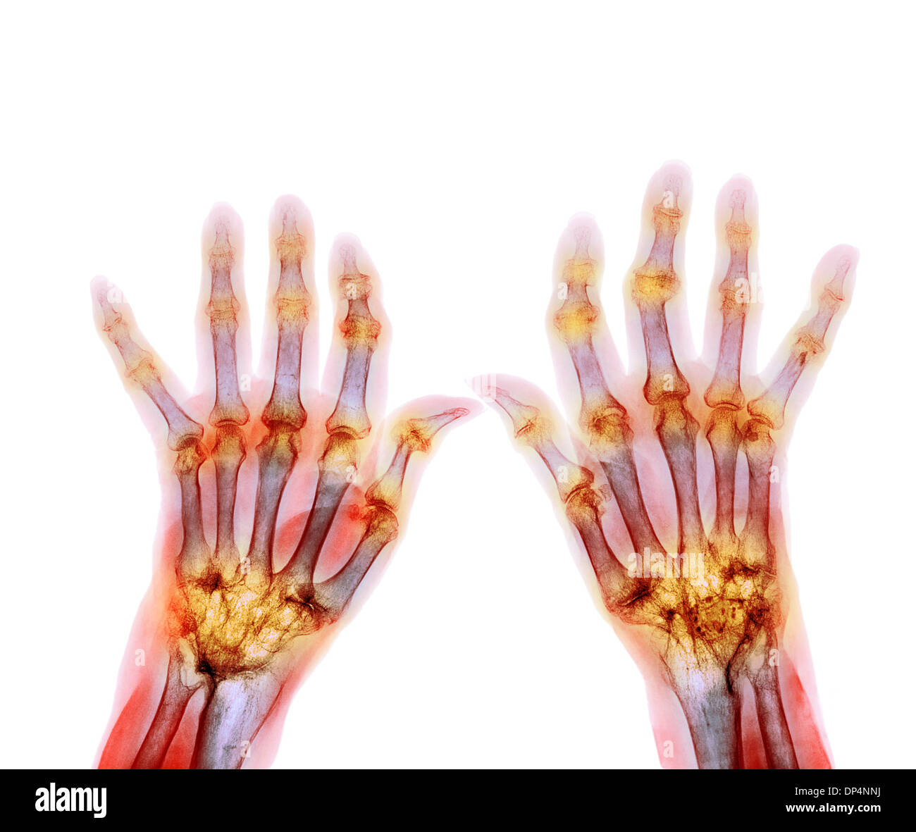 Rheumatoid arthritis, X-ray Stock Photo
