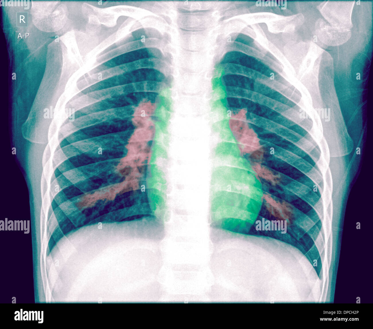 Chest x-ray of a 3 year old female baby with signs of pneumonia in both lungs Front View Stock Photo