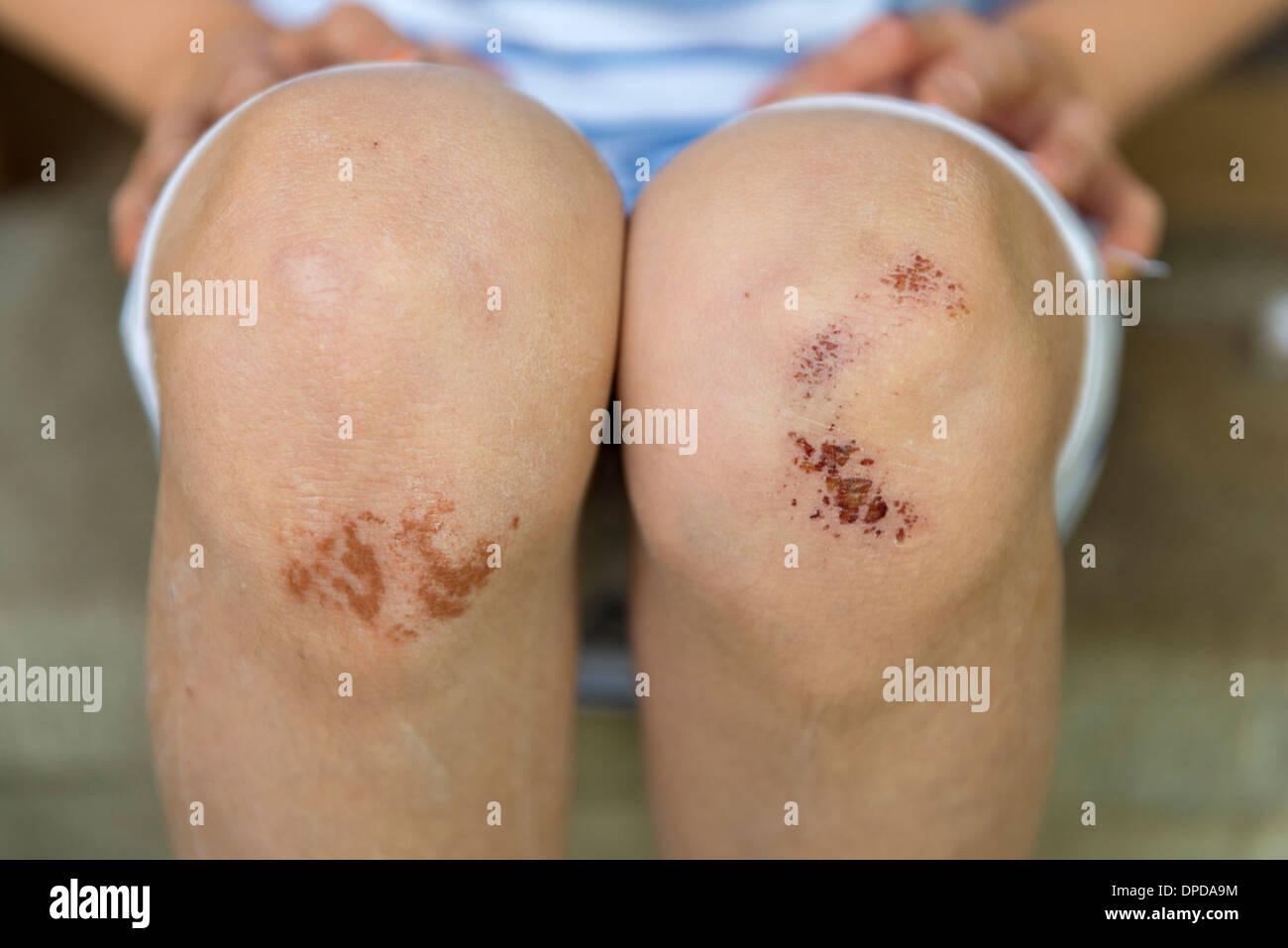 Graze at knees of a girl Stock Photo