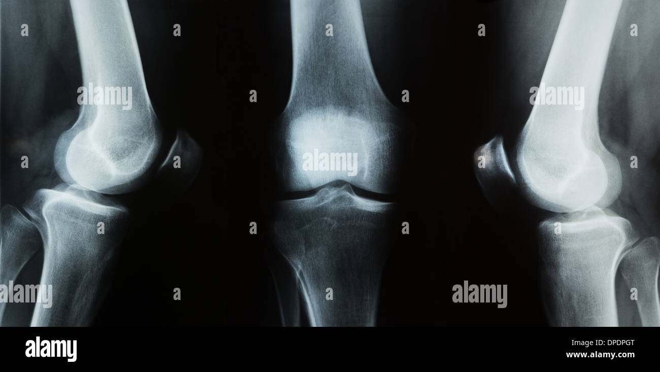 Tibia x ray hi-res stock photography and images - Alamy