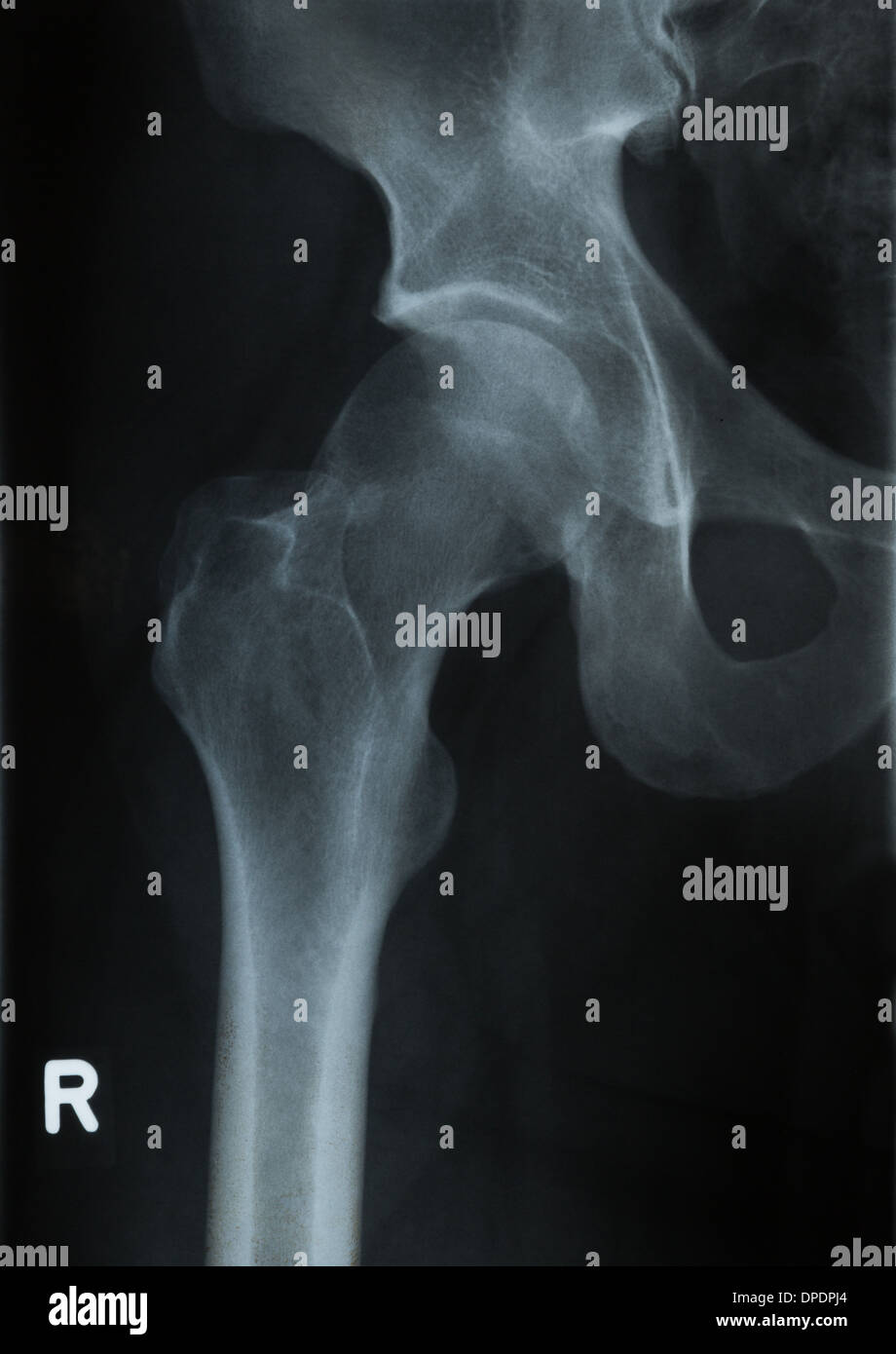 Radiology x-ray photograph of human hip Stock Photo