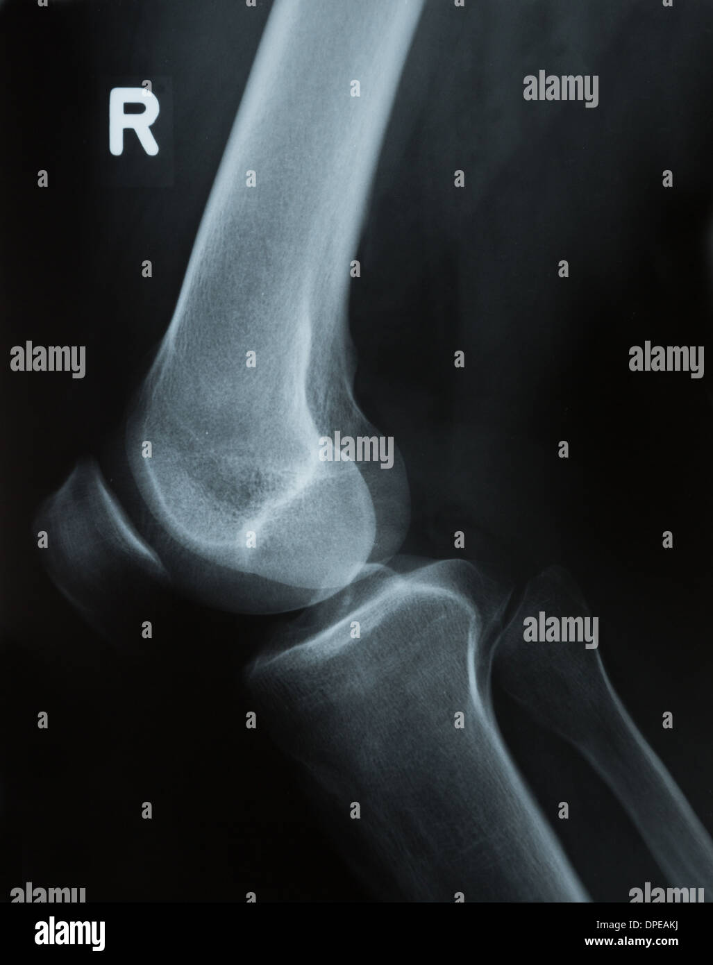 Tibia and fibula High Resolution Stock Photography and Images - Alamy