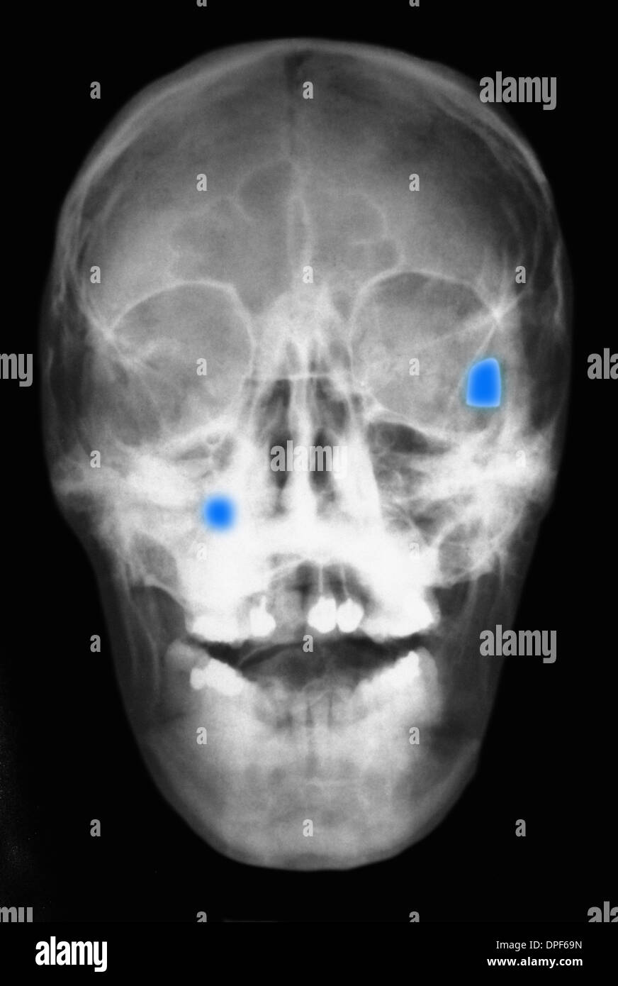 X-ray of skull showing two bullets Stock Photo