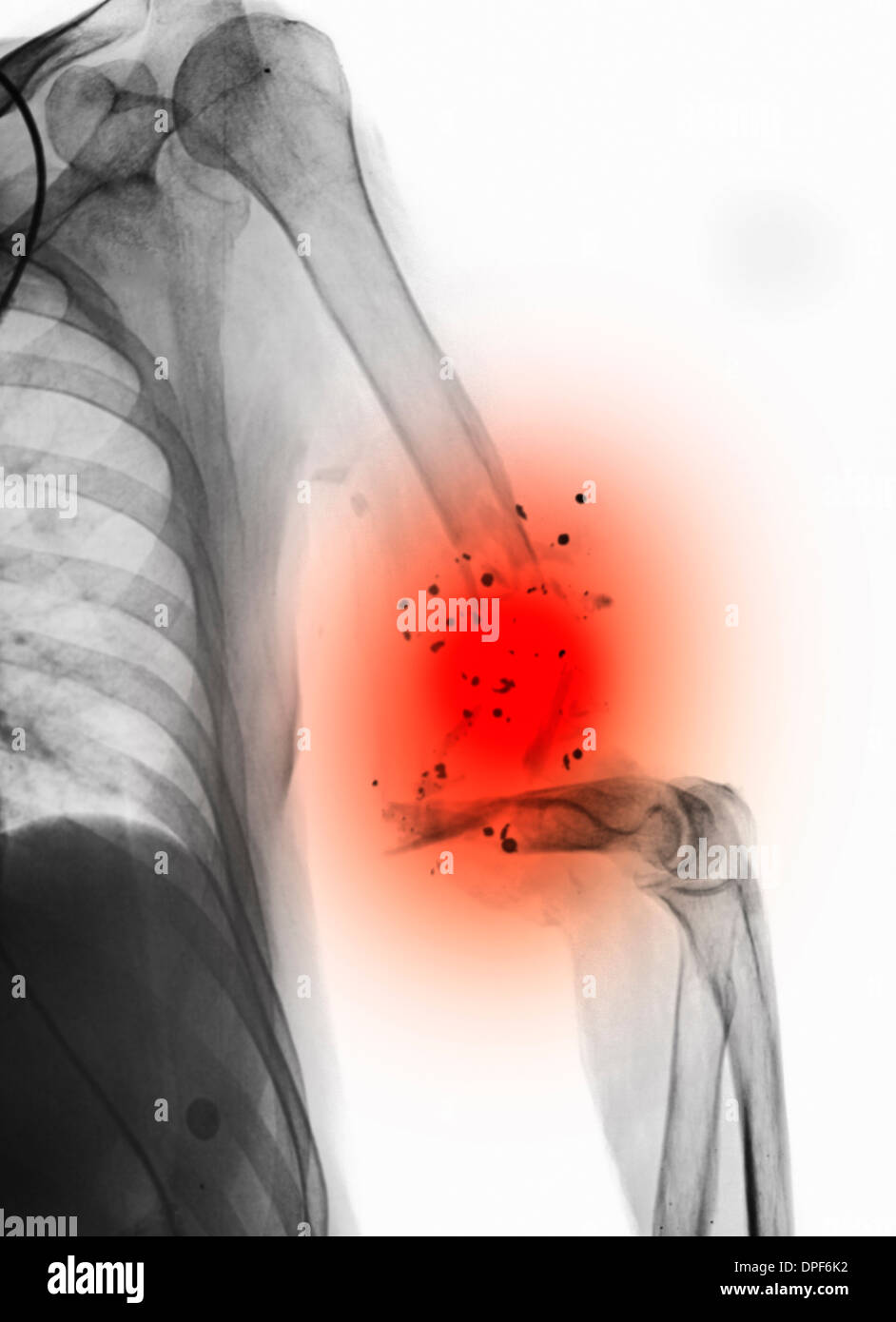 X-ray showing gunshot wound to humerus Stock Photo