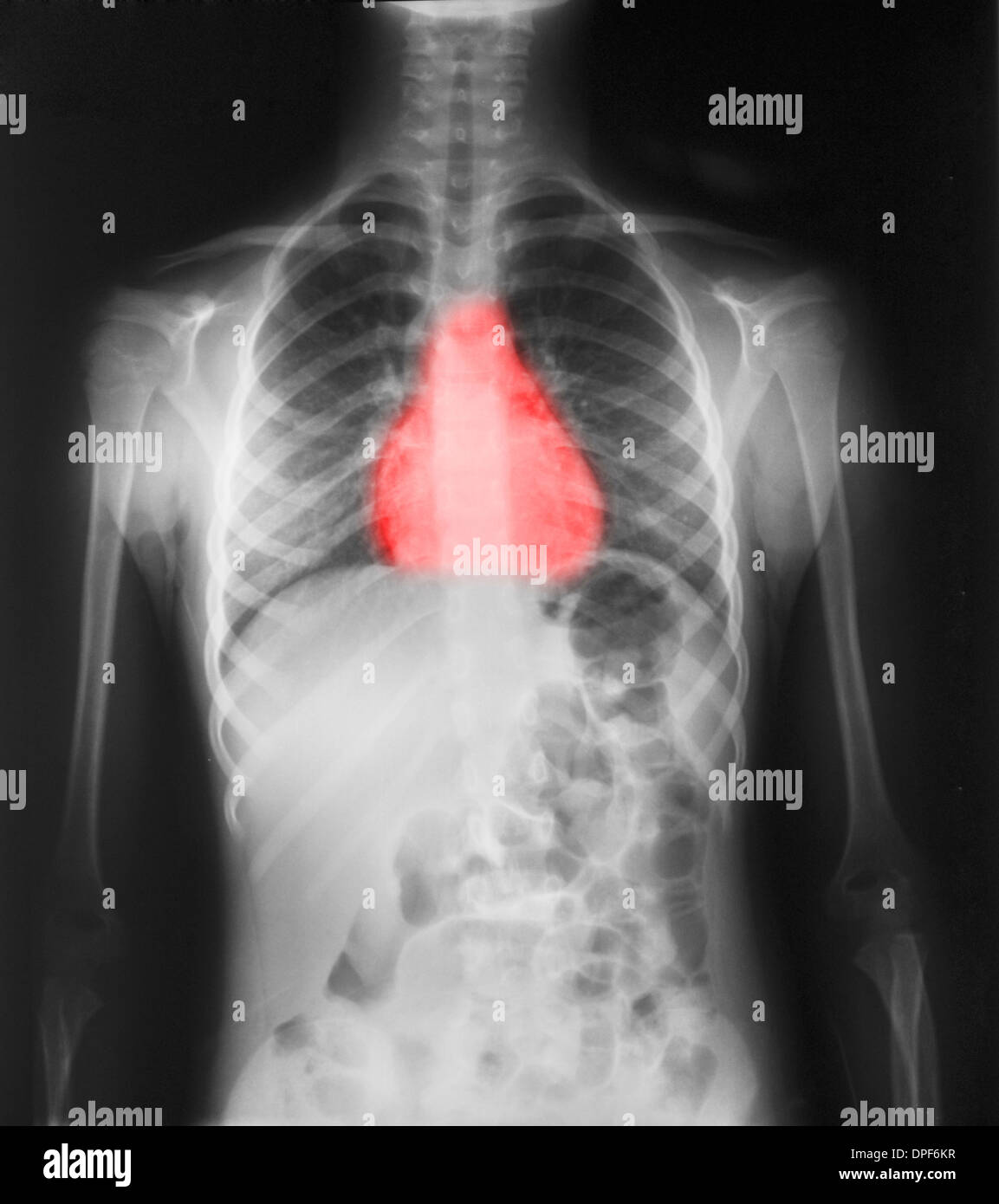 Normal chest x-ray of 7 year old girl Stock Photo - Alamy
