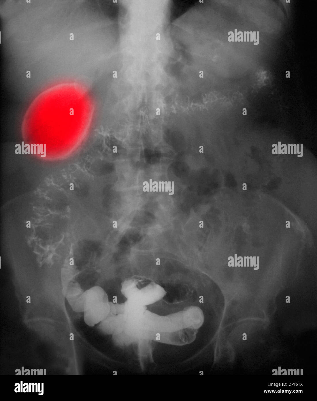 X-ray of abdomen showing porcelain gall bladder Stock Photo