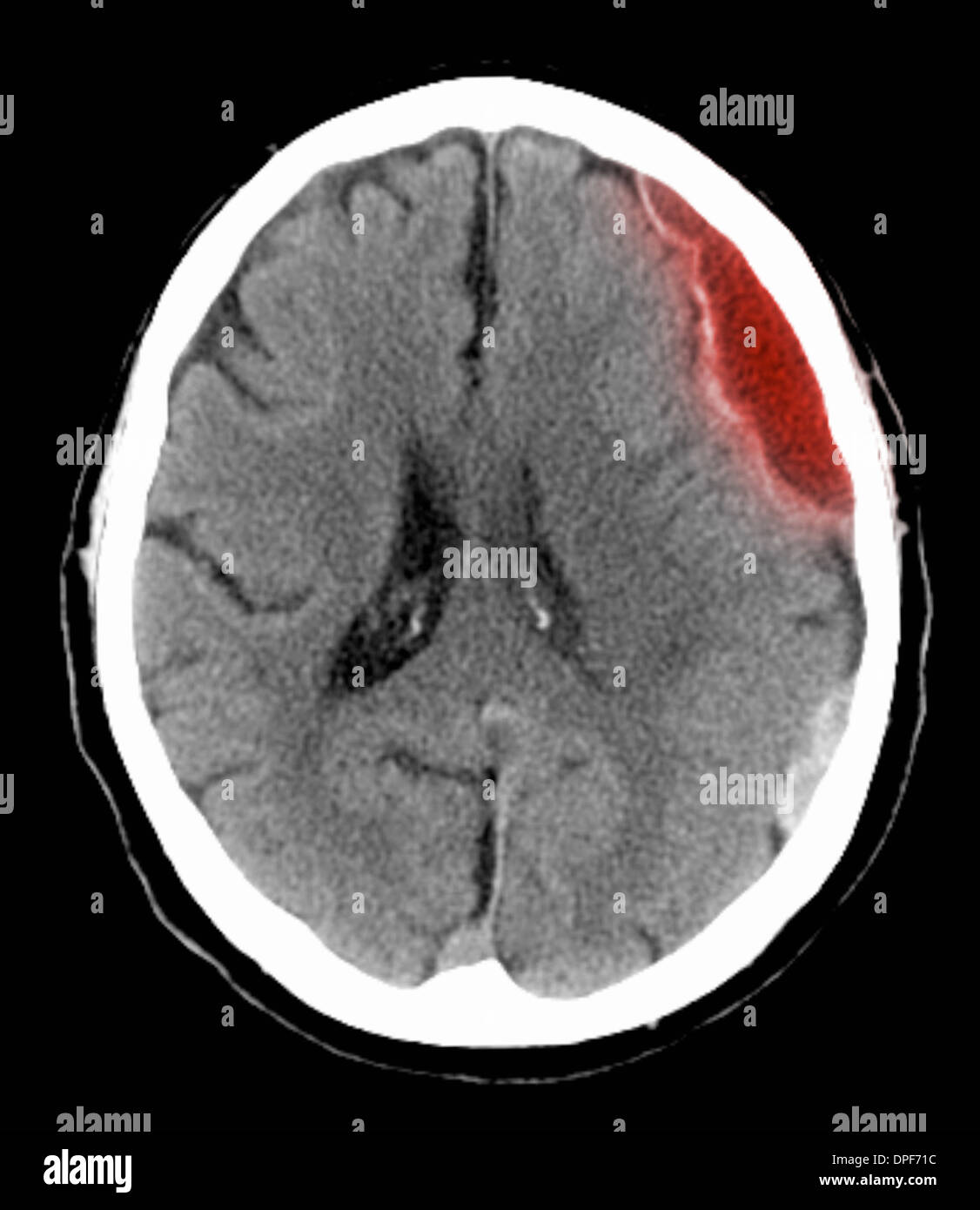 CT scan of brain showing subdural hematoma Stock Photo