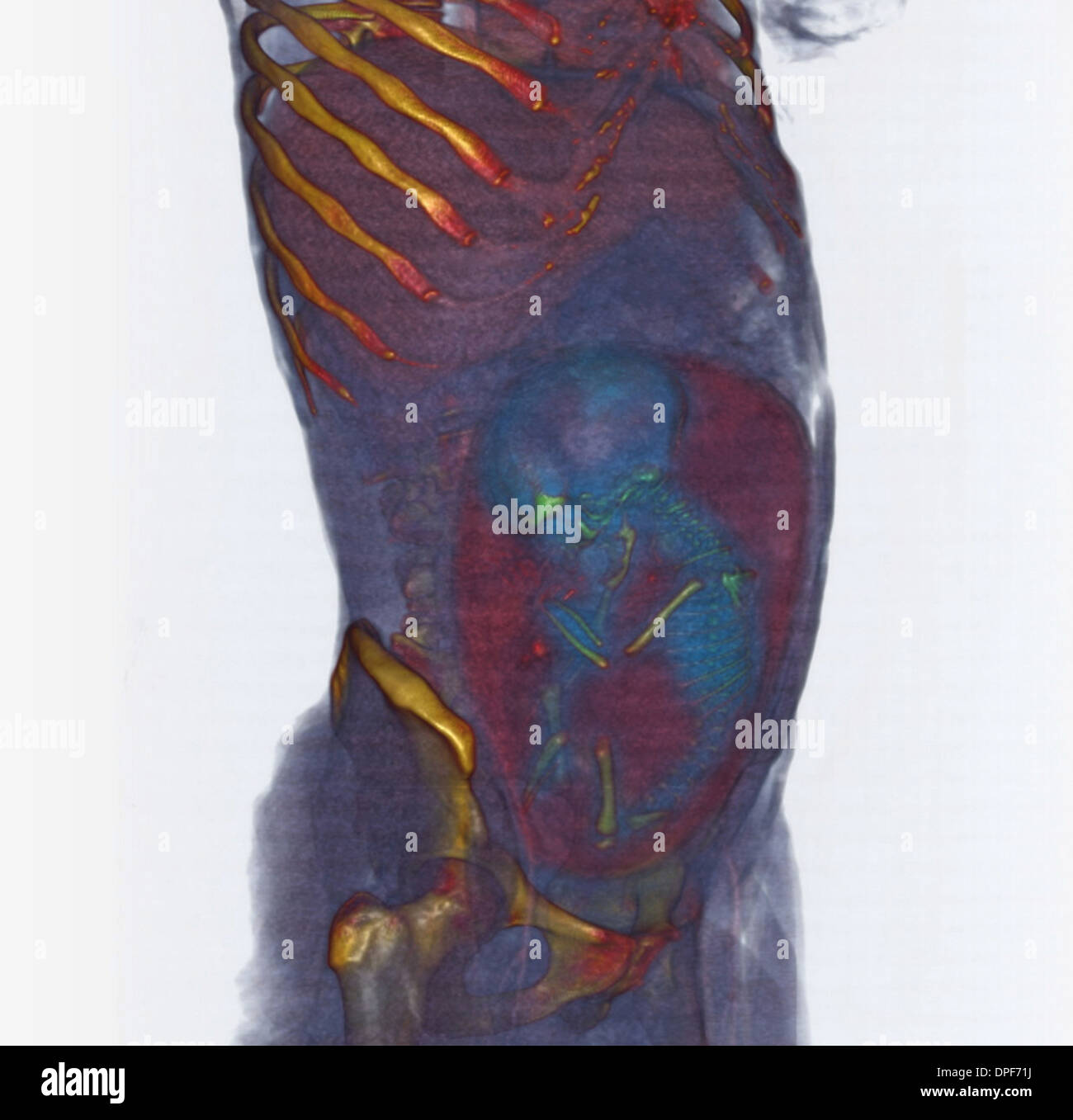 CT scan of abdomen showing 36 week old fetus Stock Photo