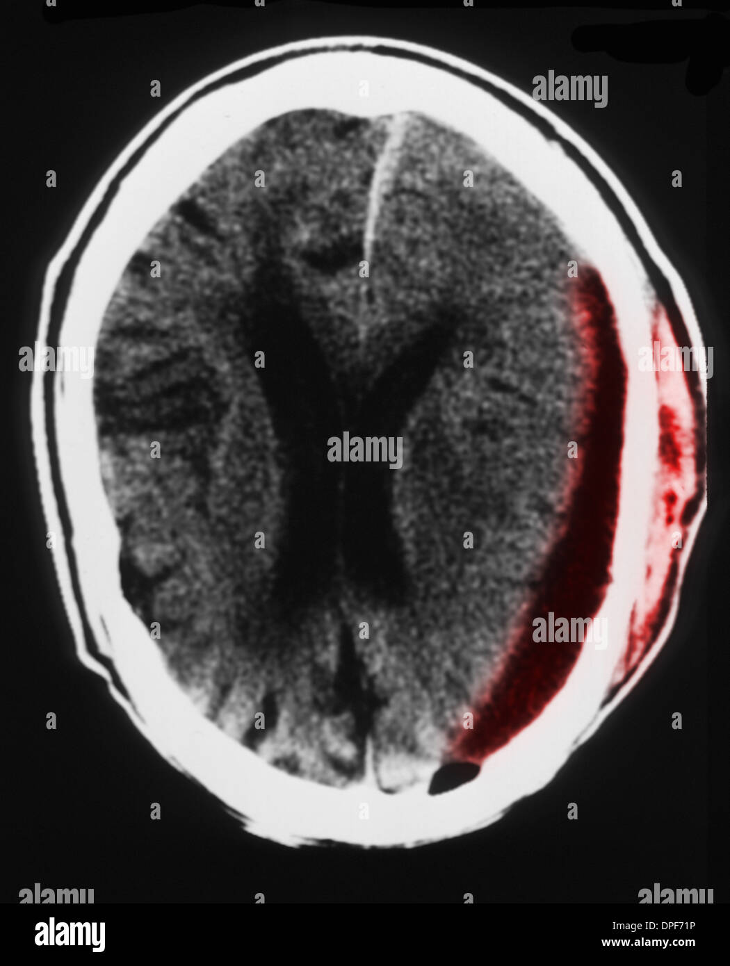 CT scan of brain showing subdural hematoma Stock Photo