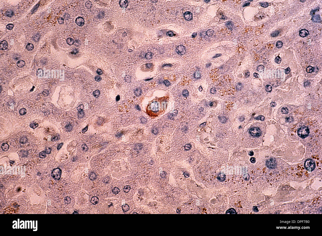 Light micrograph of metastases in breast tissue Stock Photo