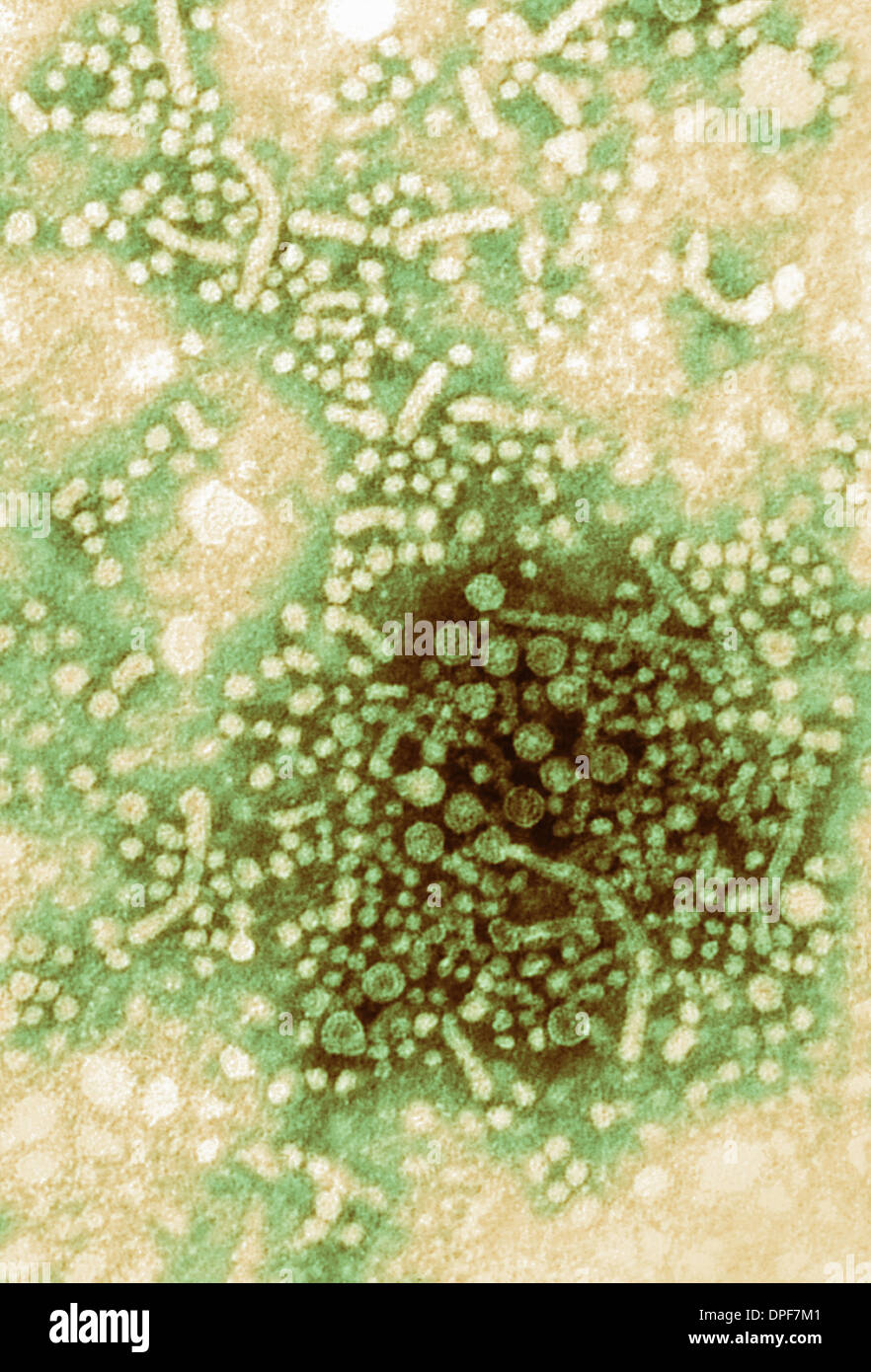 TEM showing hepatitis B virus particles Stock Photo