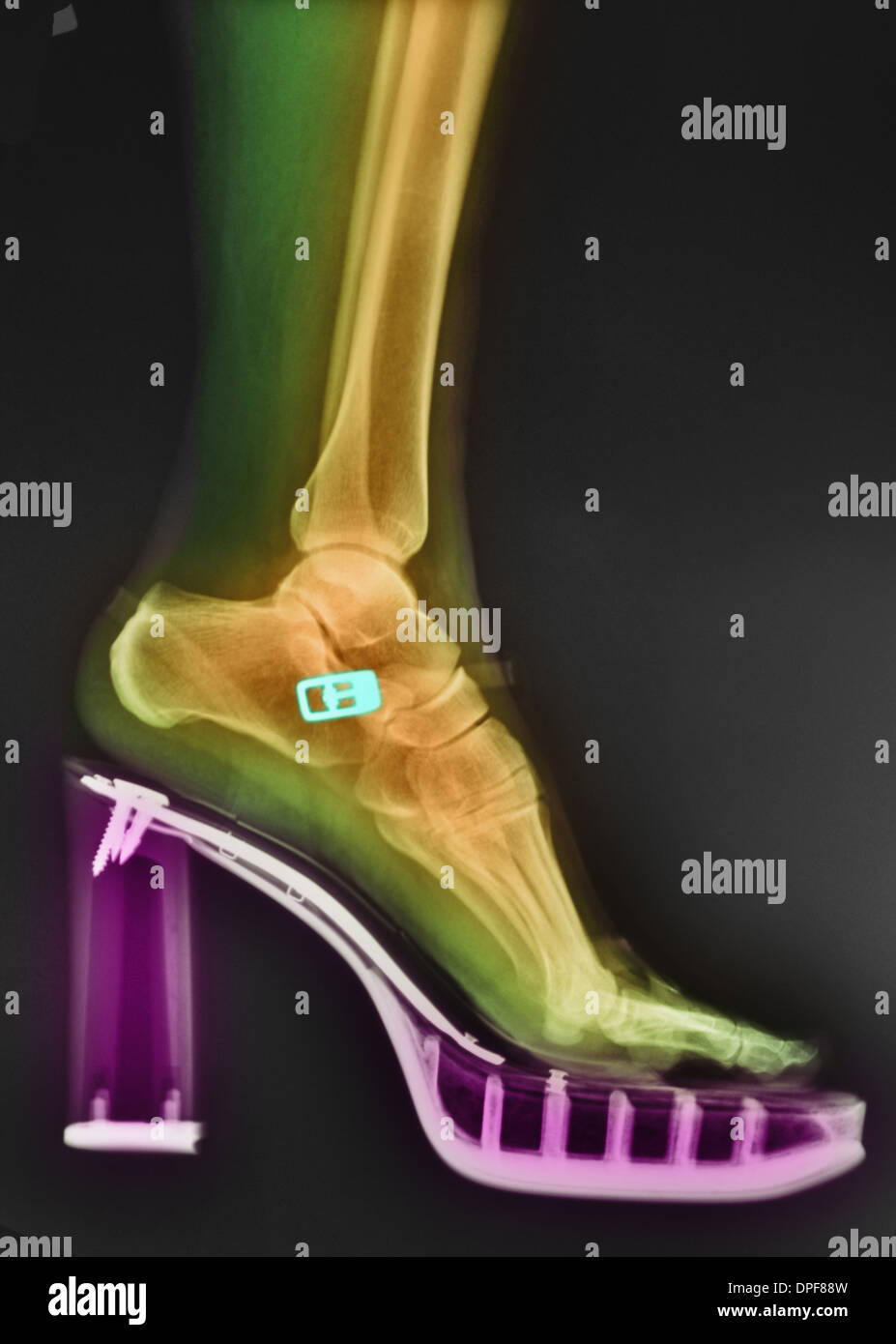 colorized x-ray of a foot in a high-heeled shoe Stock Photo