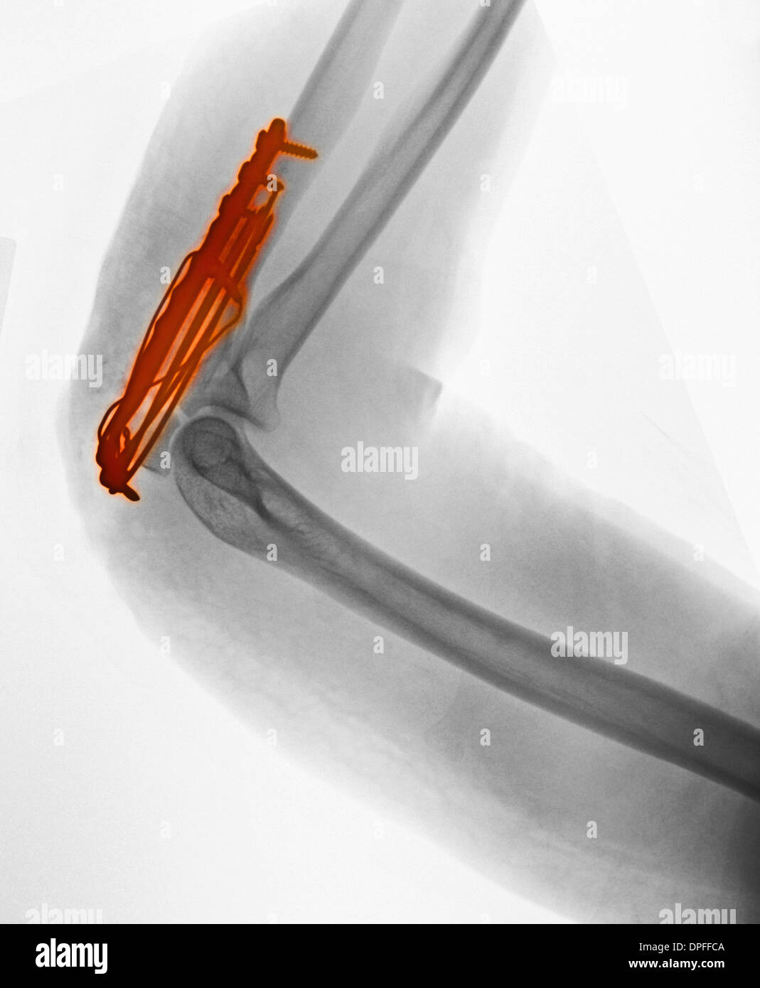 x-ray showing a fracture of the proximal ulna Stock Photo
