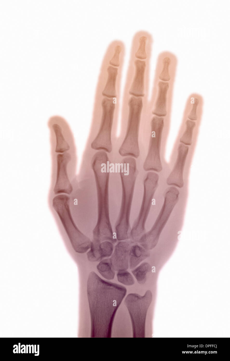X ray normal hand hires stock photography and images Alamy
