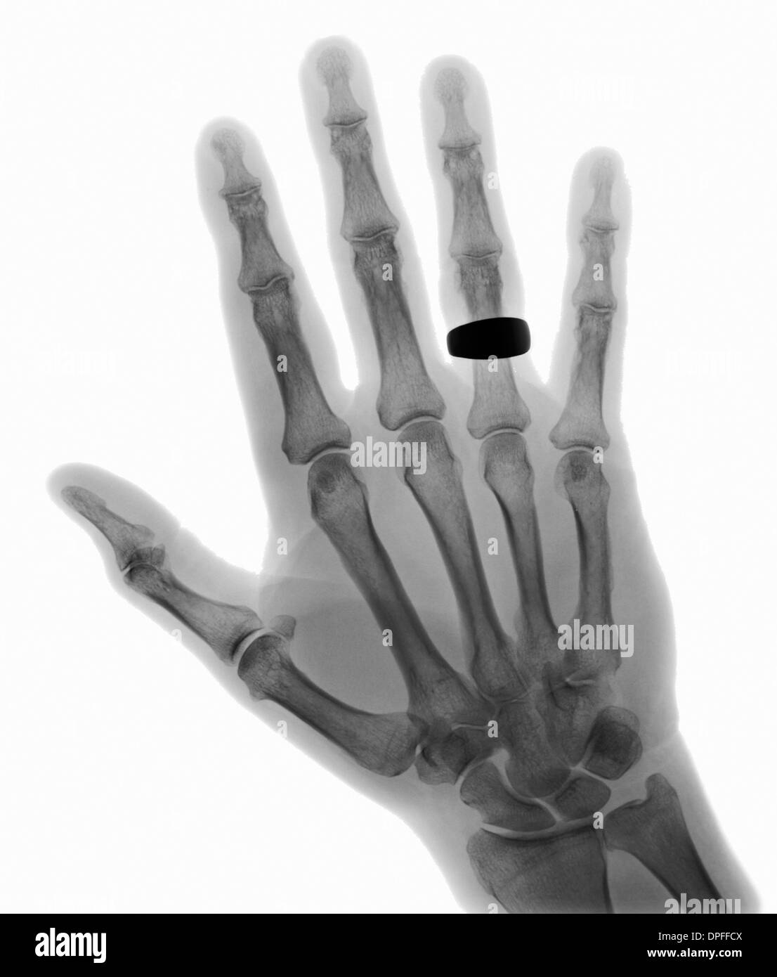 normal x-ray of the hand showing a wedding band Stock Photo