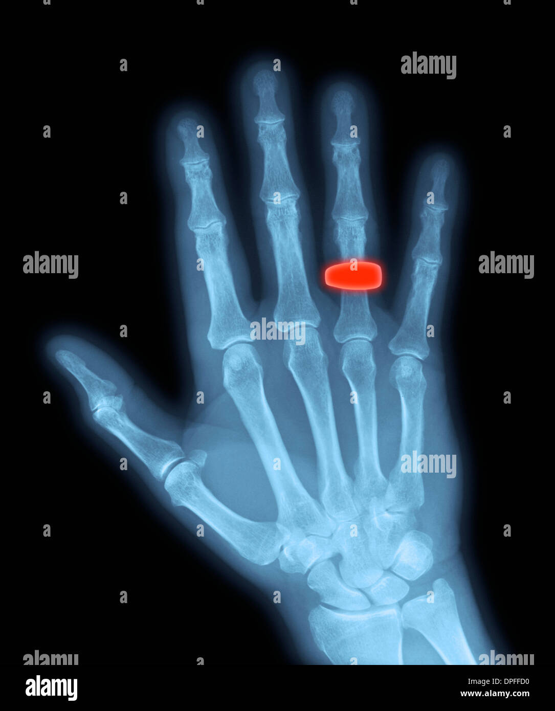 normal x-ray of the hand showing a wedding band Stock Photo