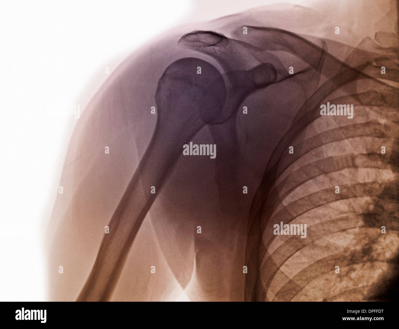 Normal shoulder x ray hi res stock photography and images alamy