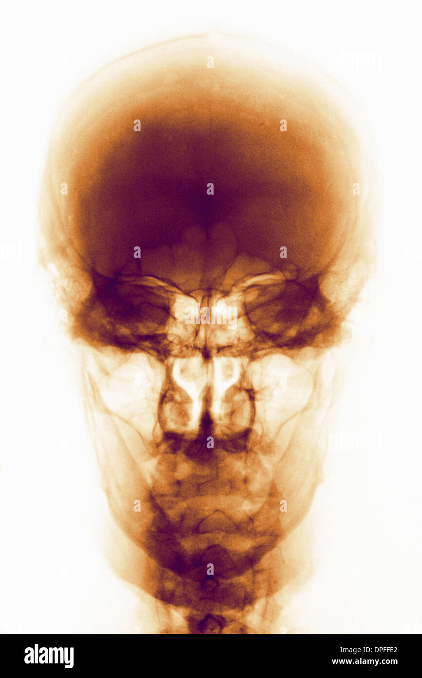 colorized x-ray of a normal human skull Stock Photo