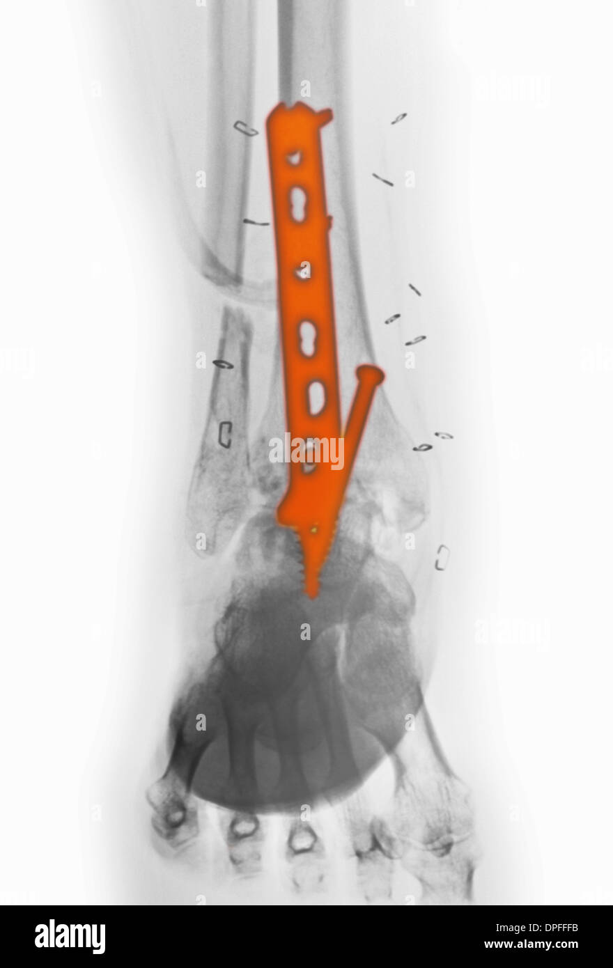 x-ray of an ankle fracture Stock Photo