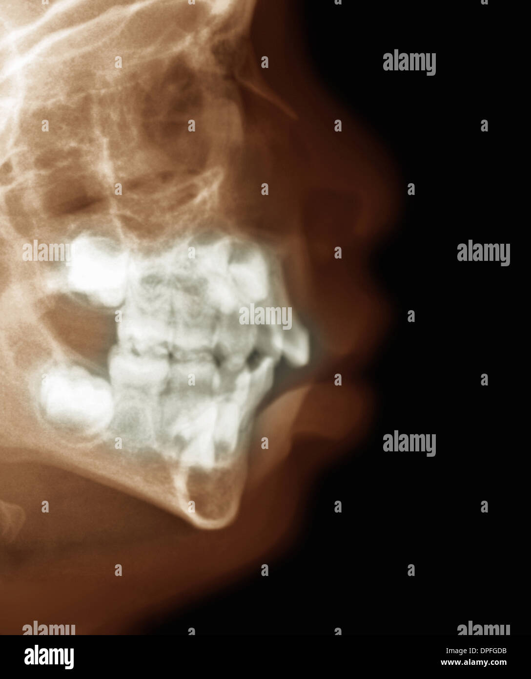 x-ray showing the head of a 2 year old boy Stock Photo