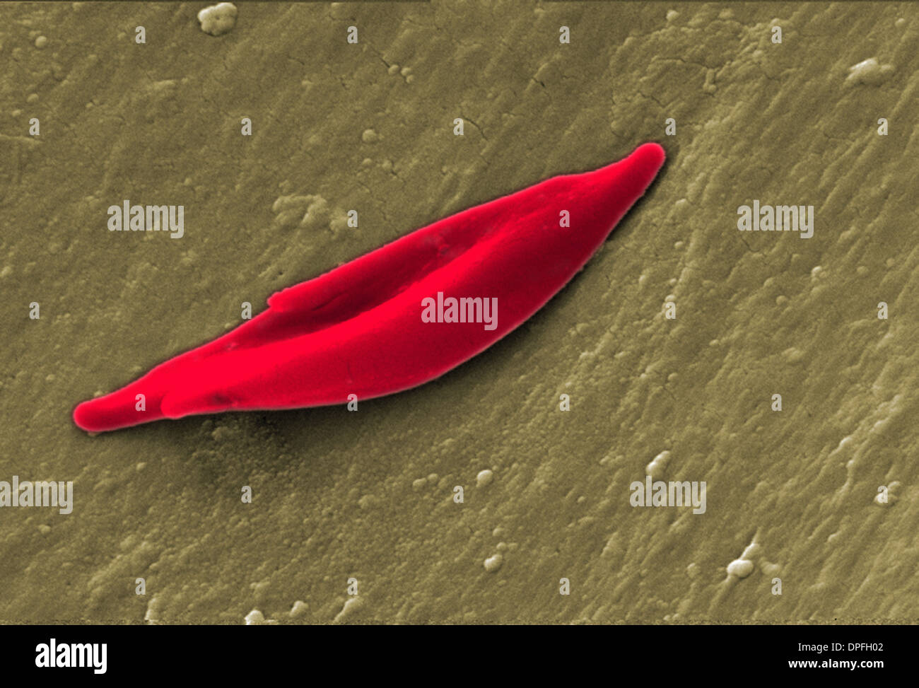 SEM of a sickle cell red blood cell Stock Photo