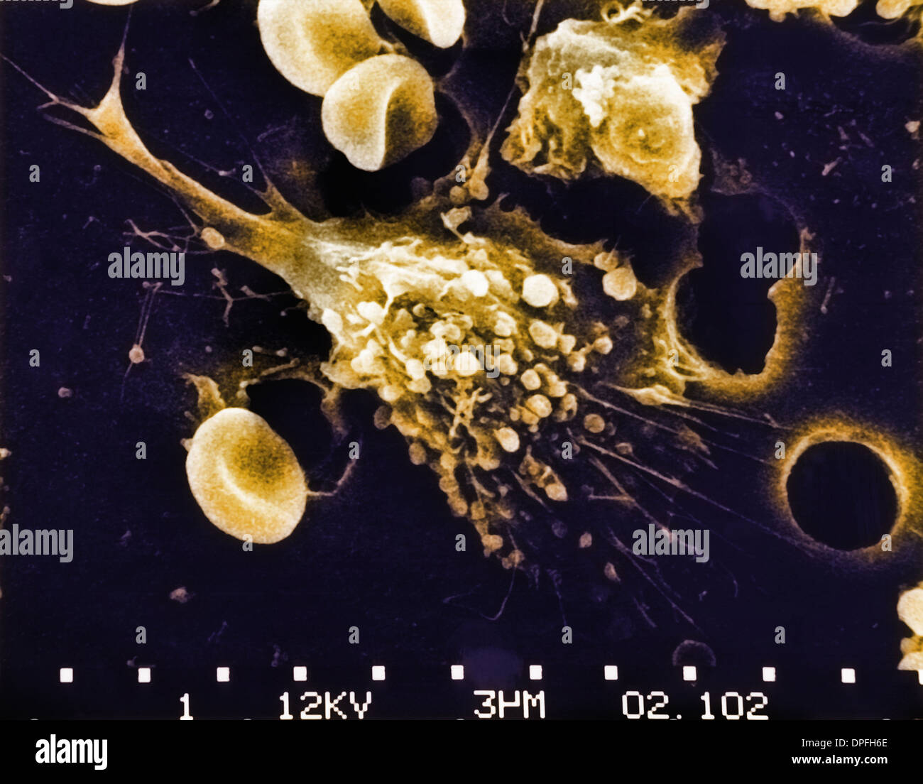 SEM of death of a Cancer Cell (6 step sequence) Stock Photo