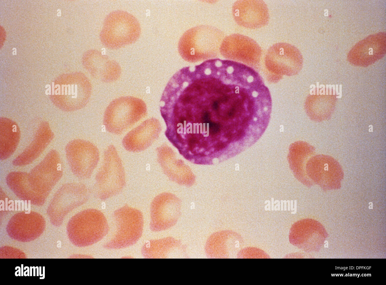 lymphocyte of Henoch-Sch?nlein purpura (HPS) Stock Photo