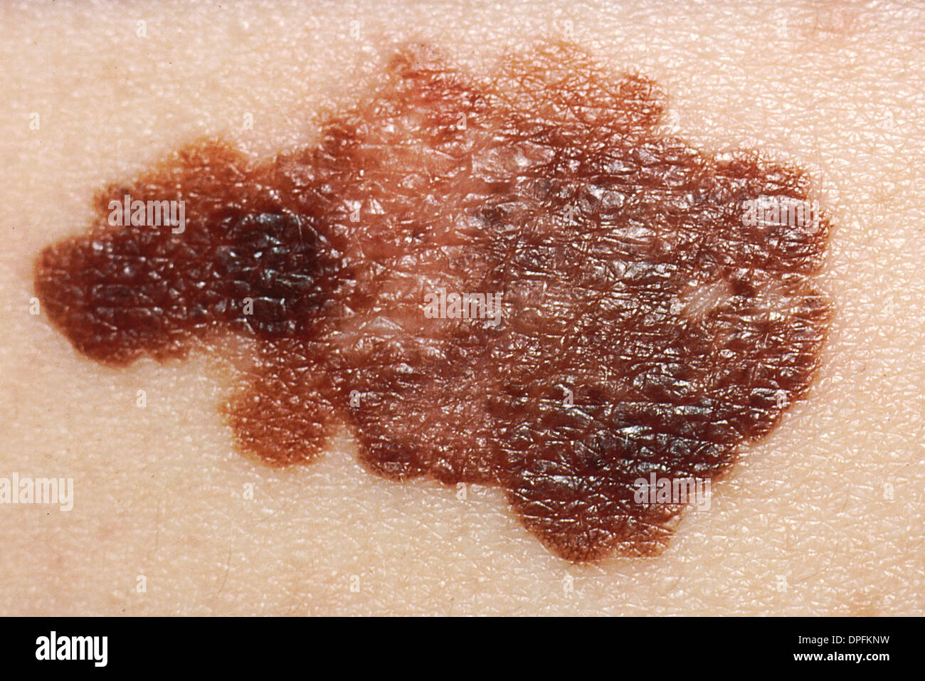 Melanoma, Skin Cancer Stock Photo