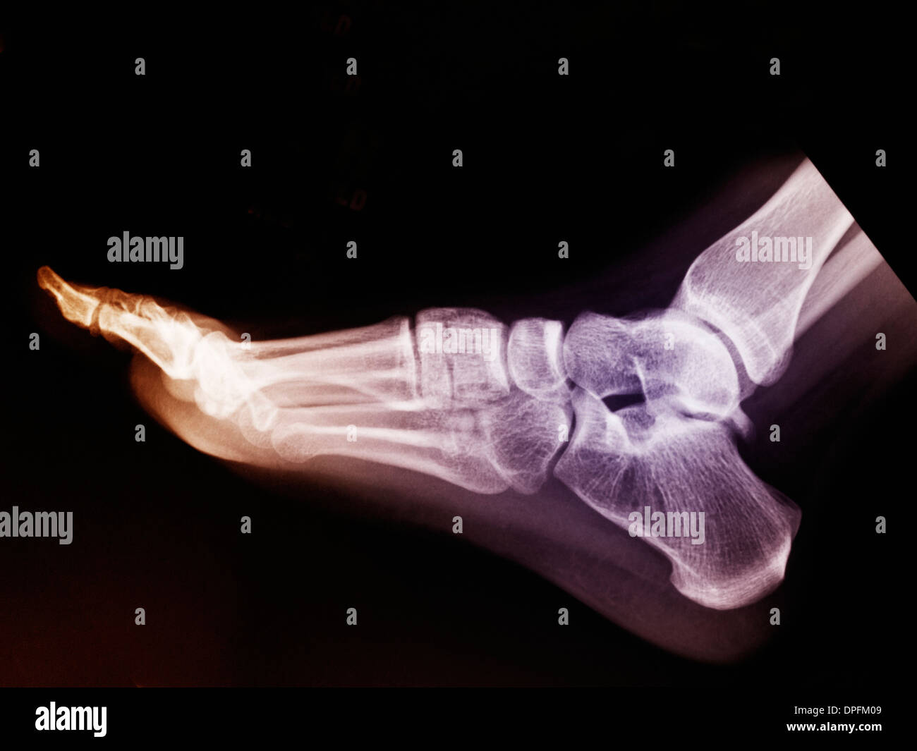 normal foot x-ray of a 17 year old woman Stock Photo