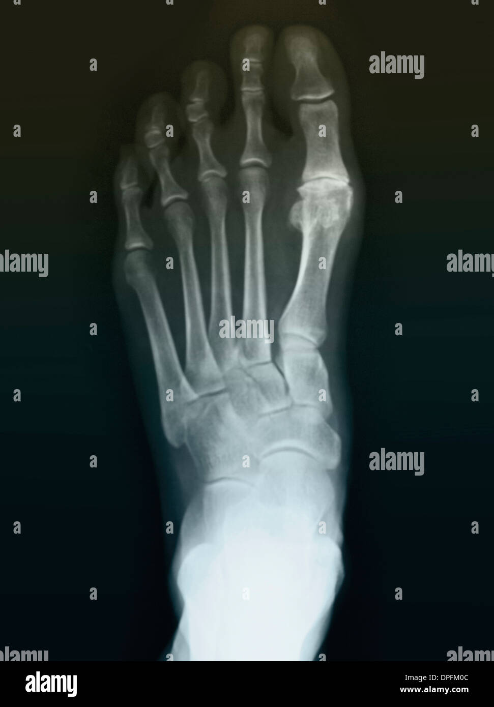 normal foot x-ray of a 59 year old woman Stock Photo