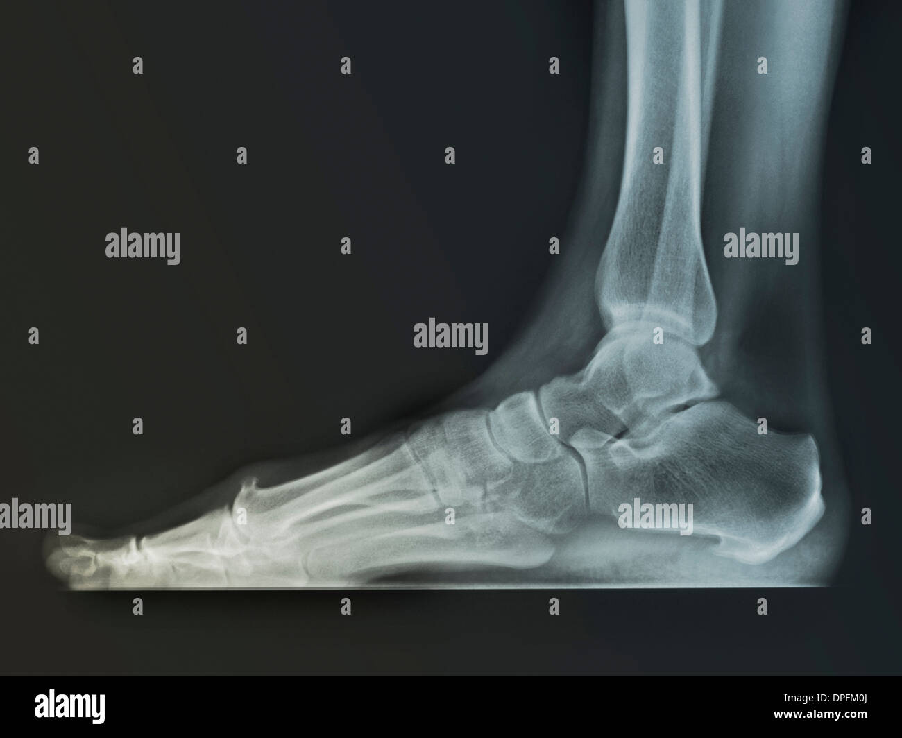 normal foot x-ray of a 59 year old woman Stock Photo
