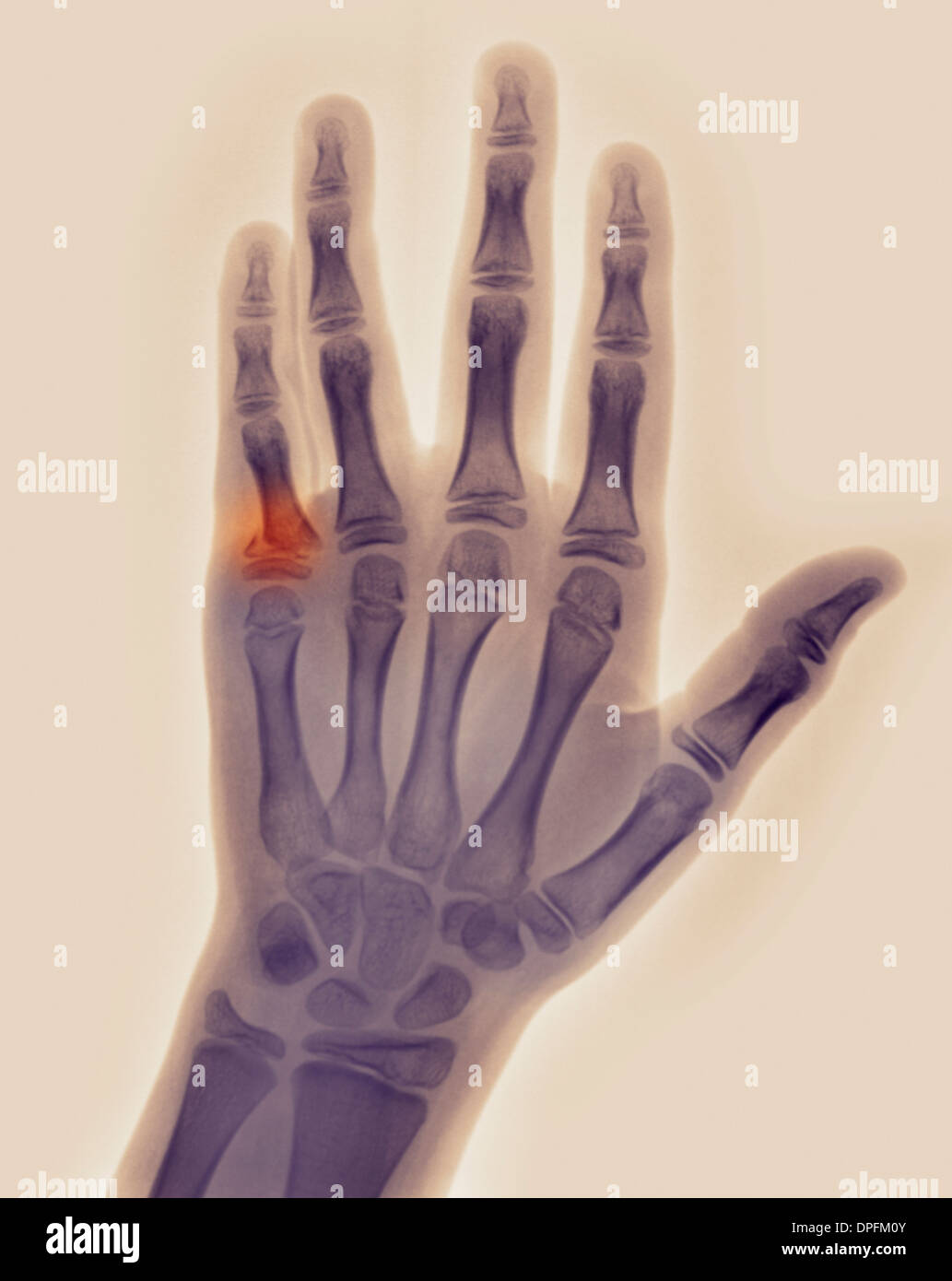 x-ray of hand with fracture of a proximal phalanx Stock Photo