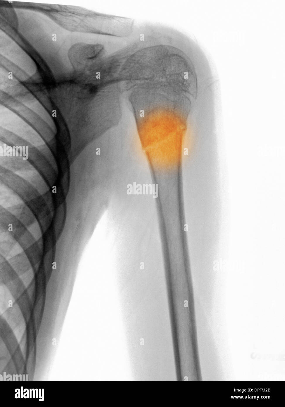 X ray Showing A Proximal Humerus Fracture Stock Photo Alamy