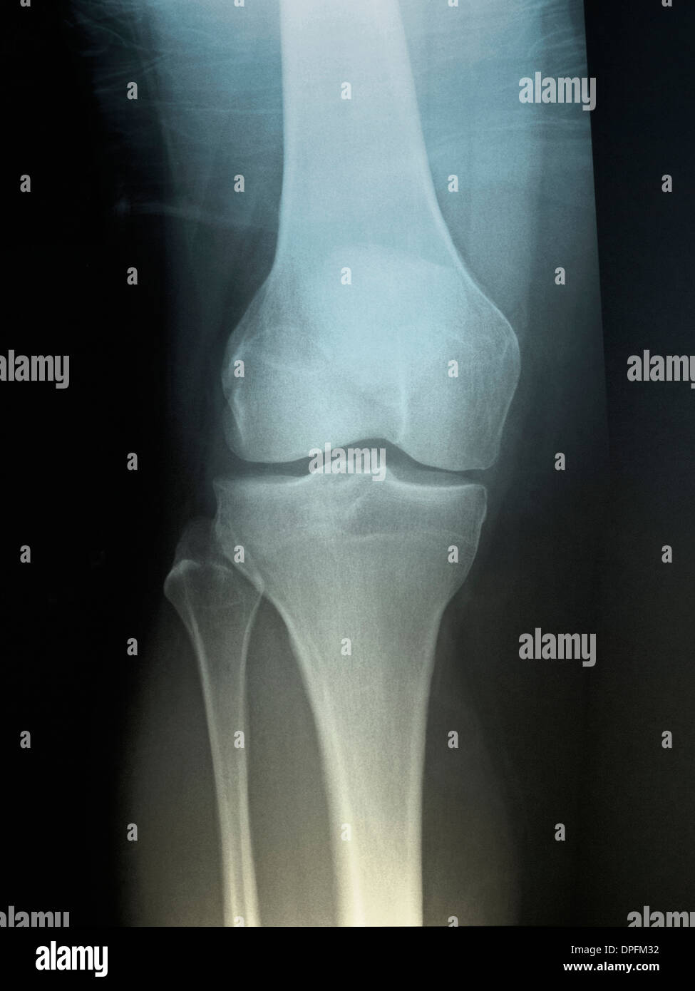 normal knee x-ray of a 58 year old man Stock Photo