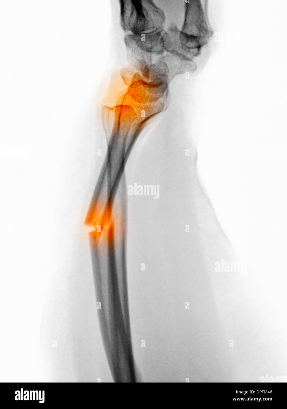 x-ray of a radius forearm fracture Stock Photo