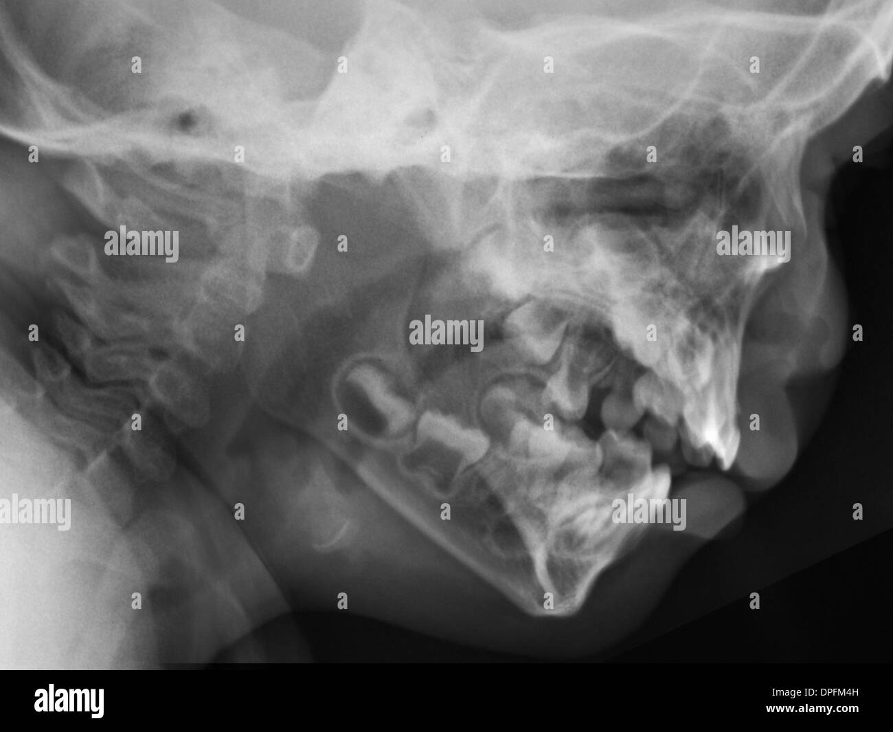 normal lateral skull x-ray of a 2 year old boy Stock Photo