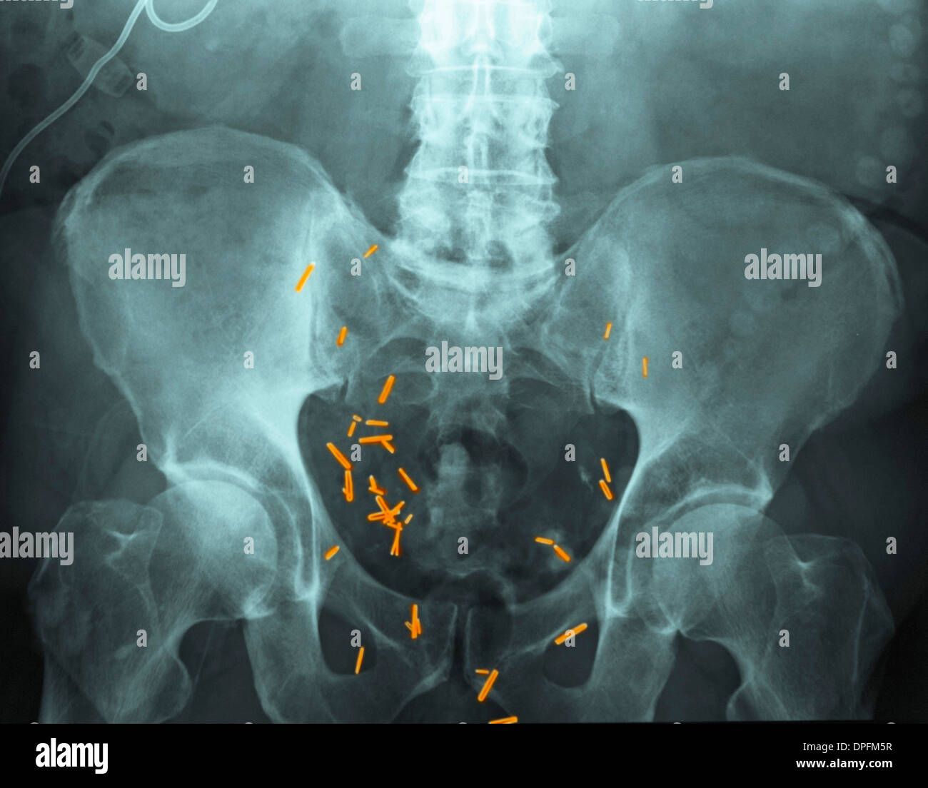 Bladder Cancer High Resolution Stock Photography And Images Alamy