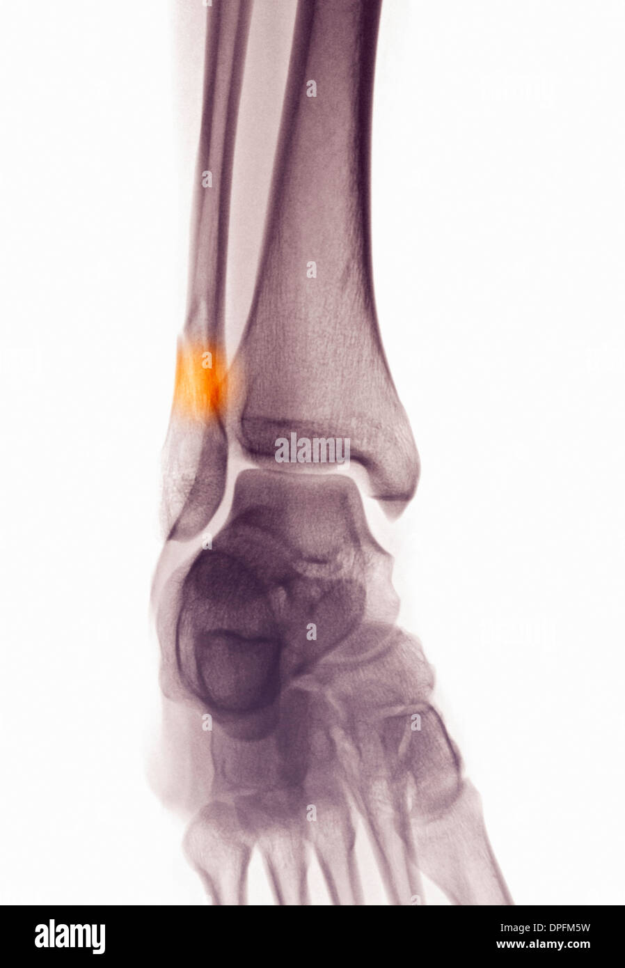 ankle x-ray showing fractured distal fibula Stock Photo