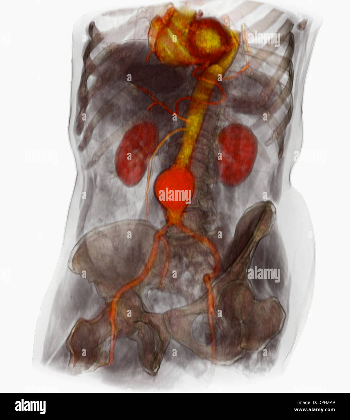 CT scan image showing an abdominal aortic aneurysm Stock Photo