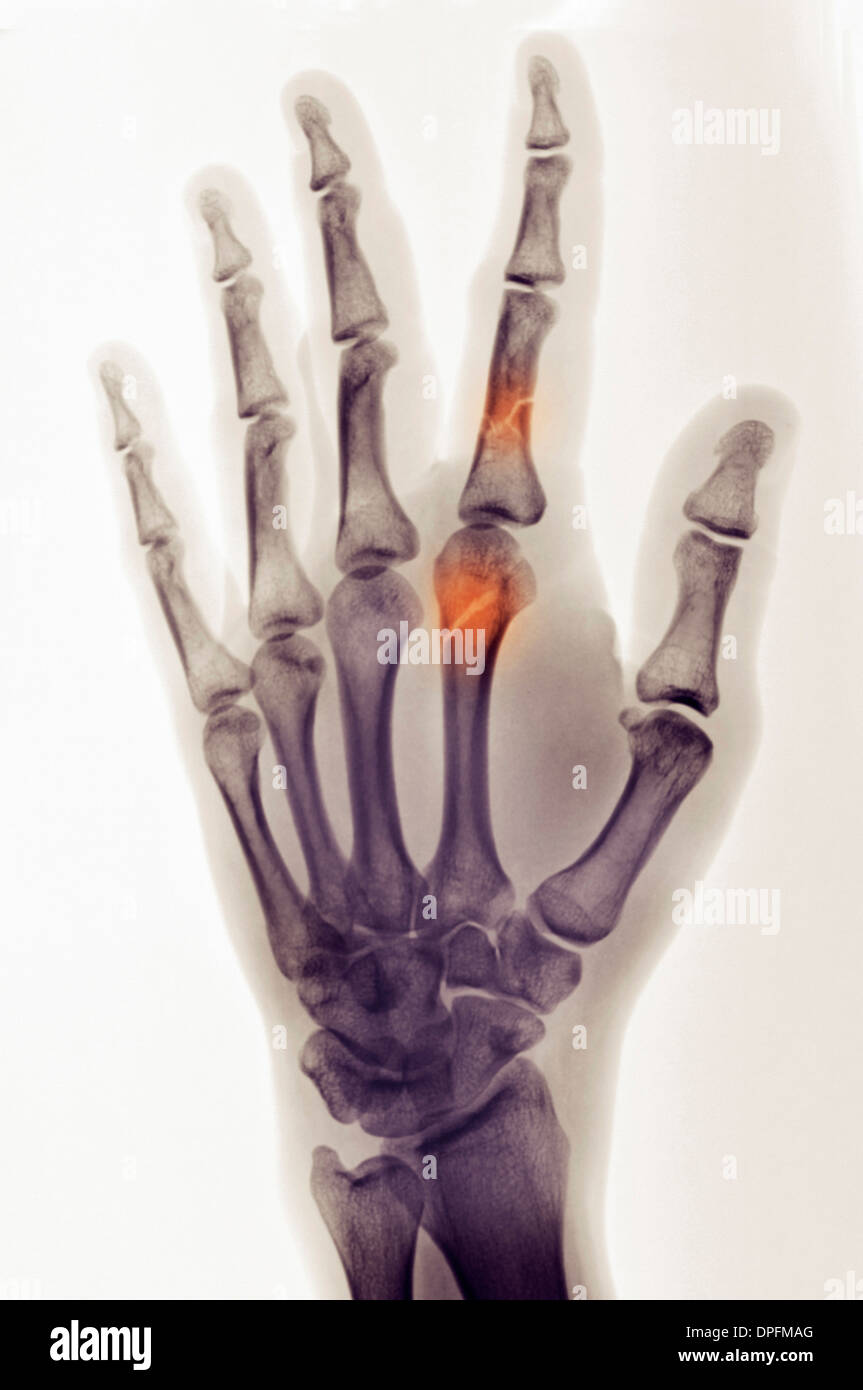 colorized x-ray of hand showing finger fractures Stock Photo