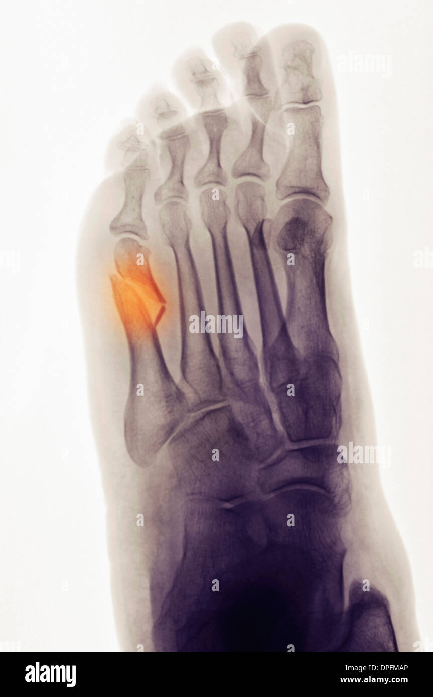x-ray of foot showing a fifth metatarsal fracture Stock Photo