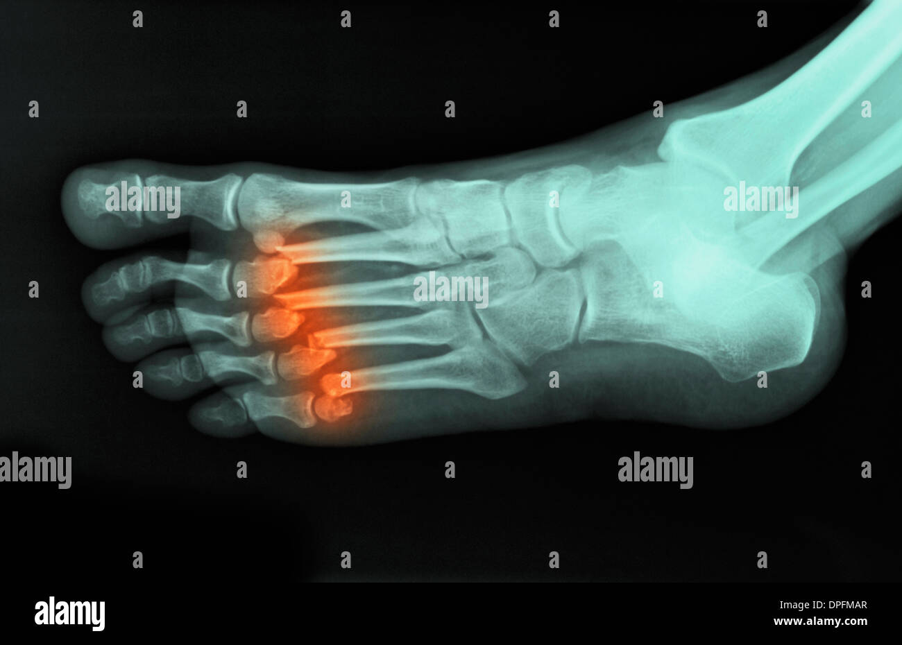 x-ray of foot showing fractured metatarsals Stock Photo