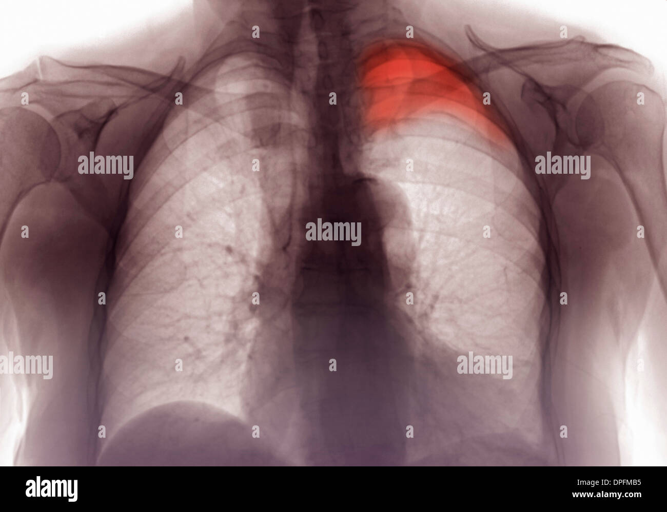 X-ray showing rib fracture and pneumothorax Stock Photo