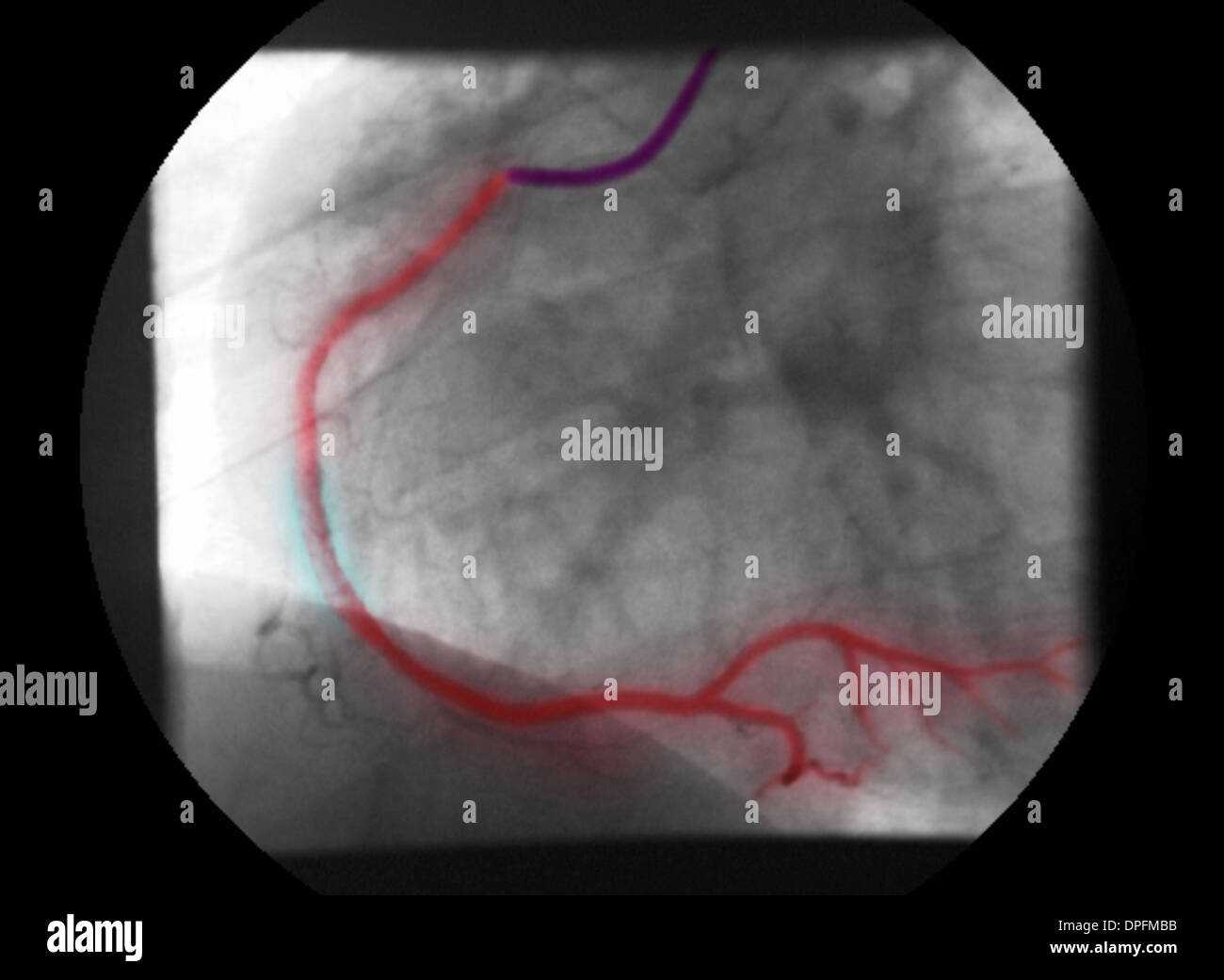 angiogram of RCA showing stenosis and repair Stock Photo