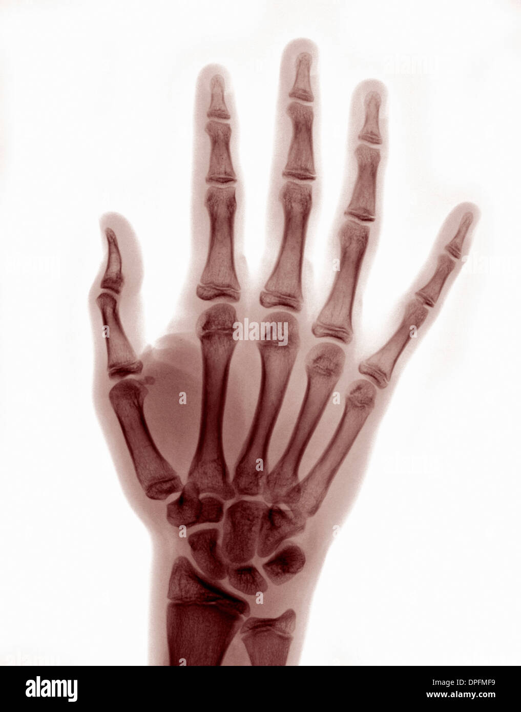 X-ray of hand showing reduced thumb dislocation Stock Photo